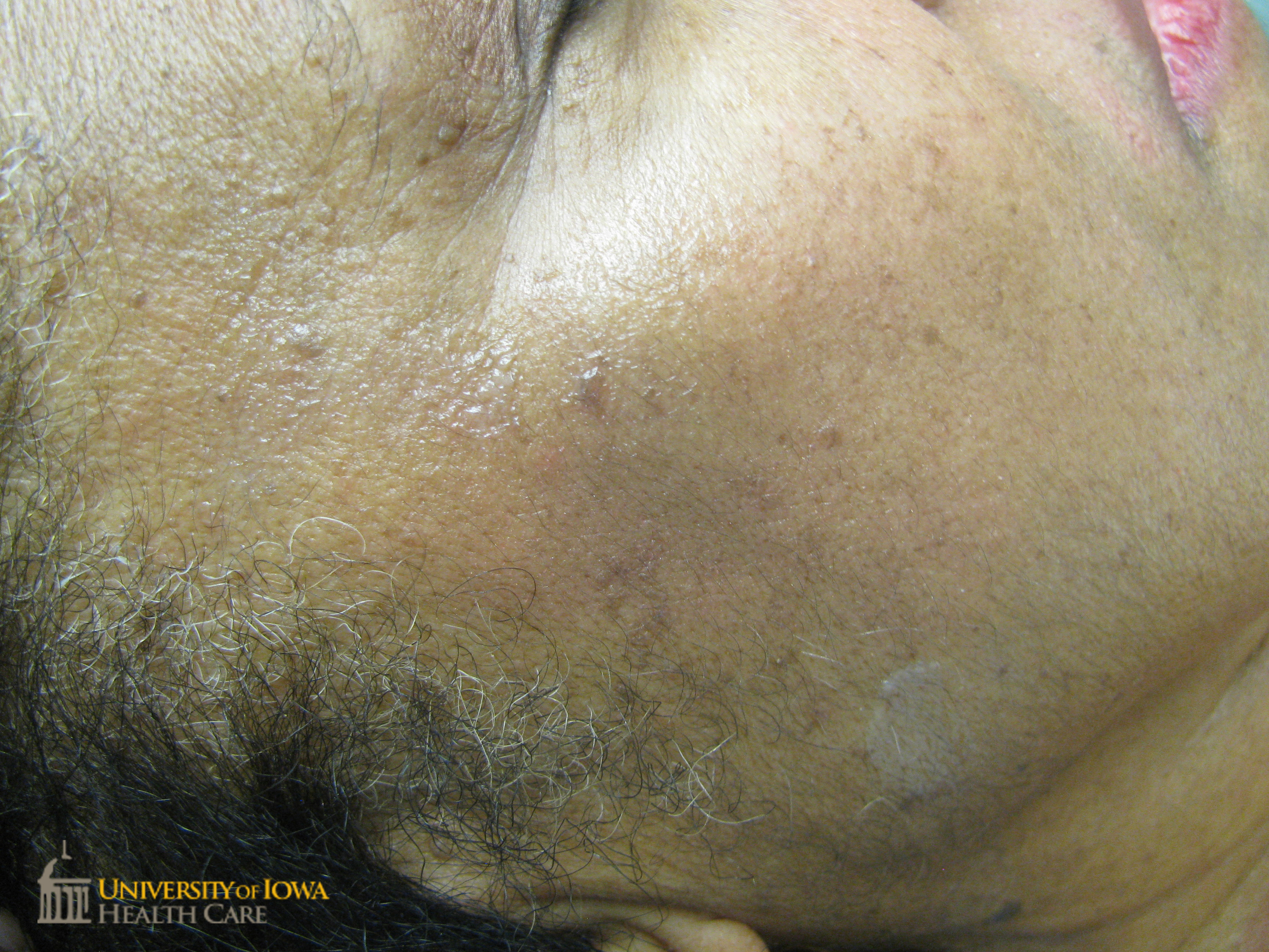 Multiple brown papules on the face. (click images for higher resolution).